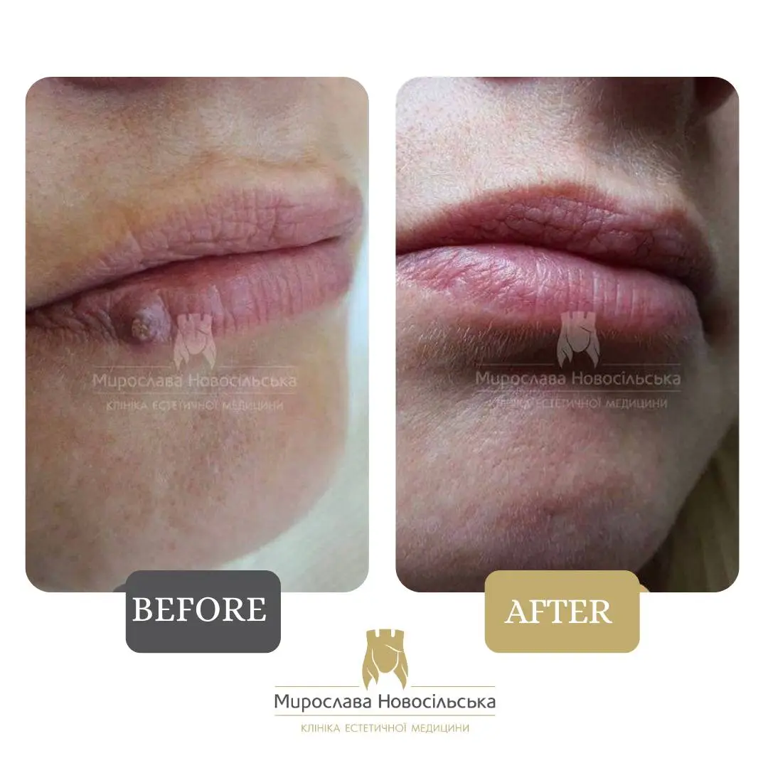 Removal of neoplasm, photo 2