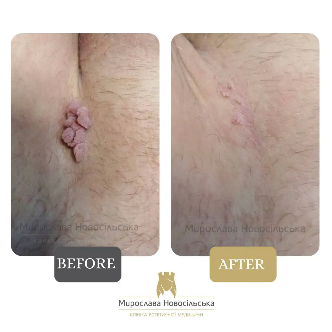 Removal of neoplasm, photo 3