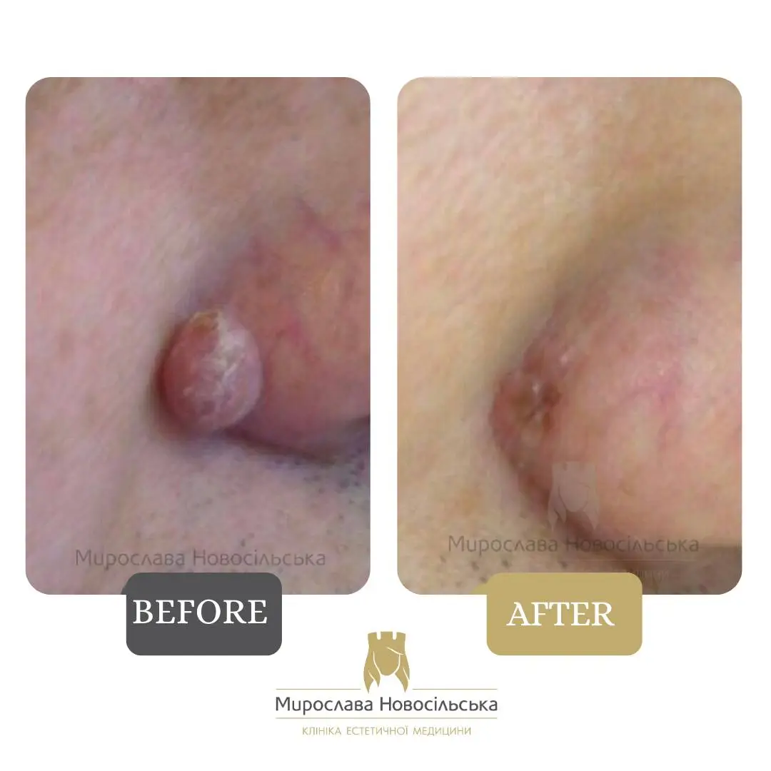 Removal of neoplasm, photo 4