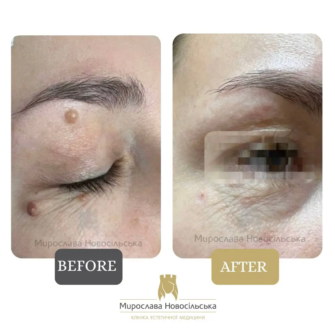 Removal of neoplasm, photo 5