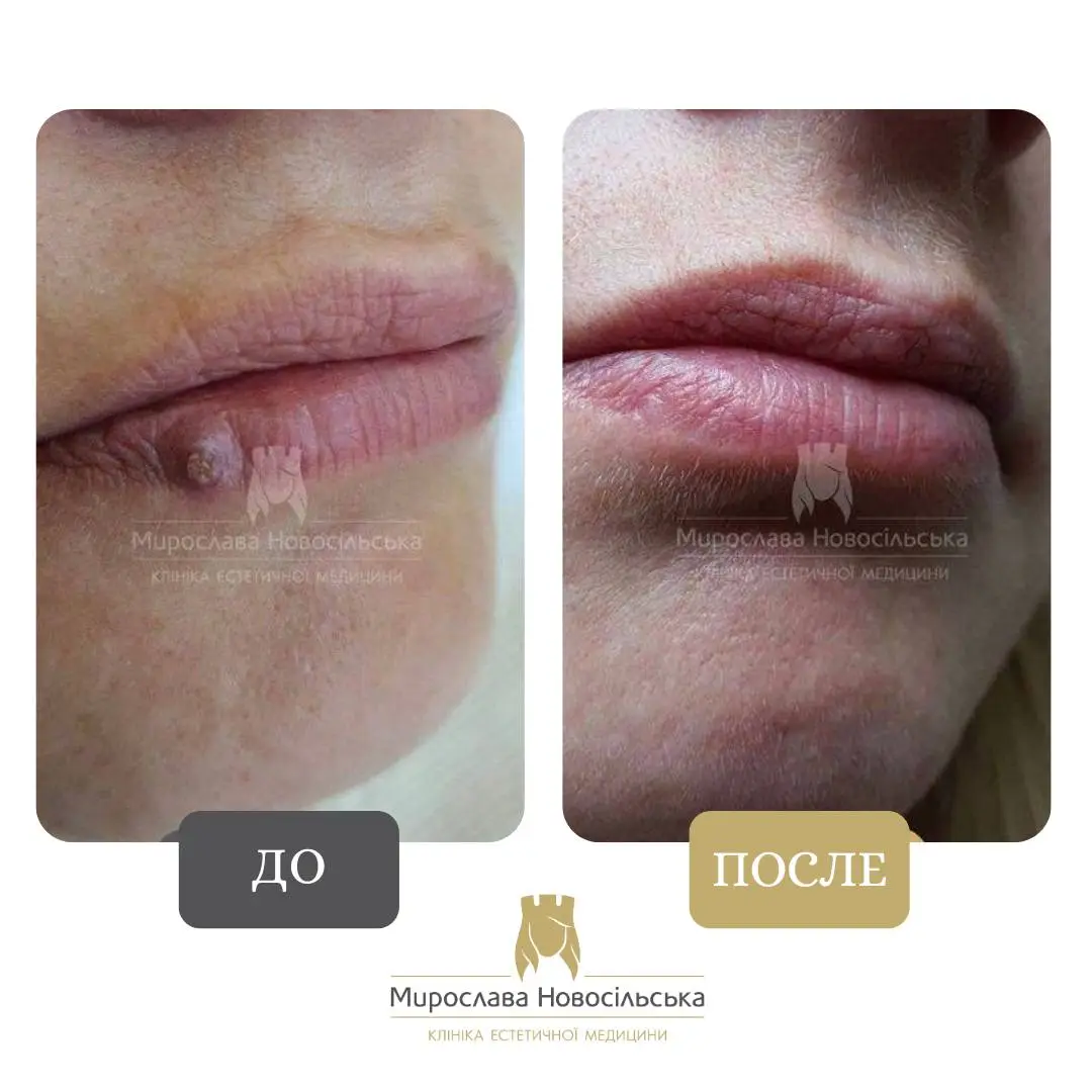 Лазерное удаление новообразования, фото 2