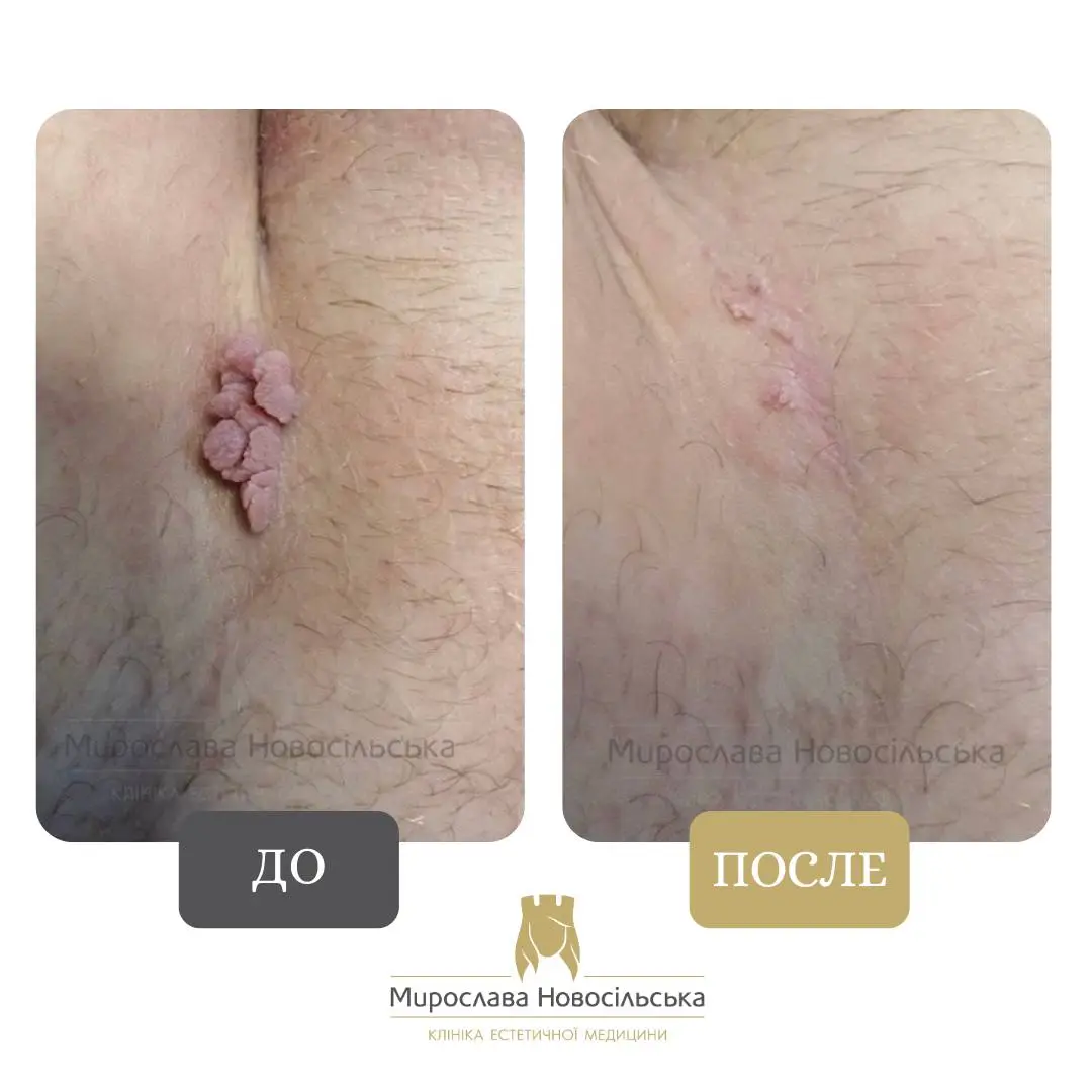 Лазерное удаление новообразования, фото 3