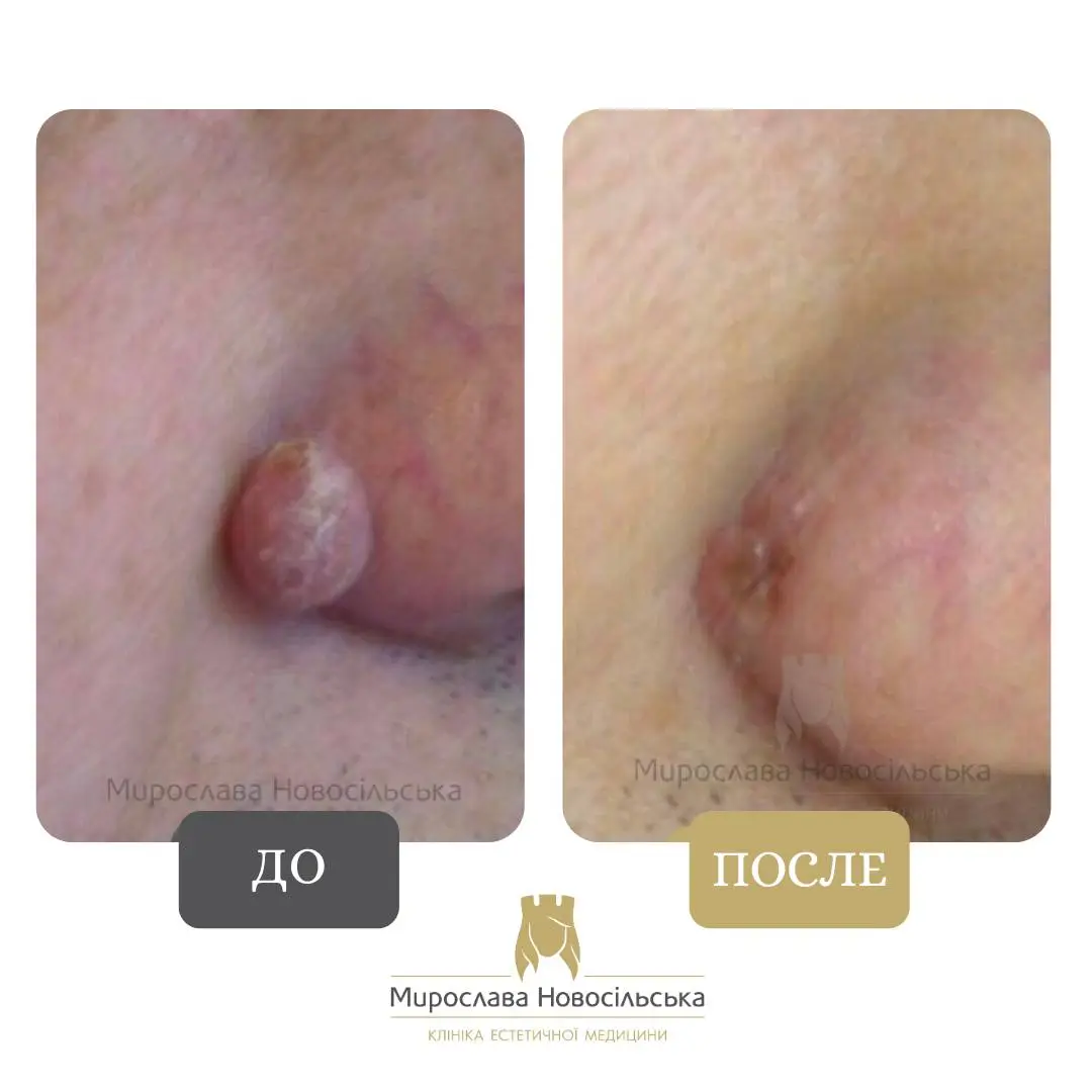 Лазерное удаление новообразования, фото 4