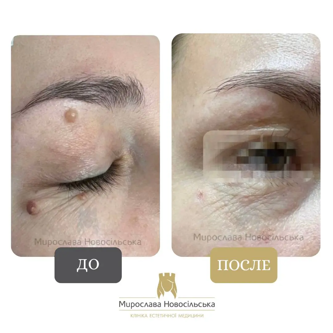 Лазерное удаление новообразования, фото 5