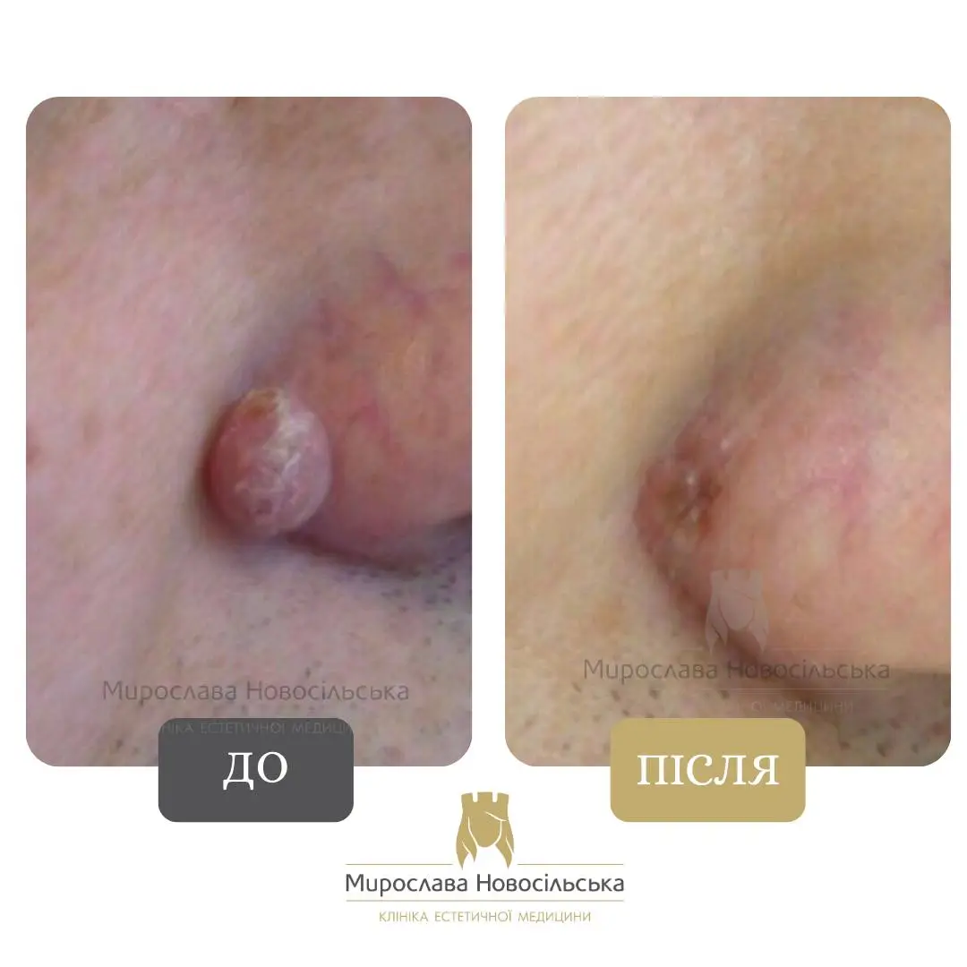 Лазерне видалення новоутворення, фото 4