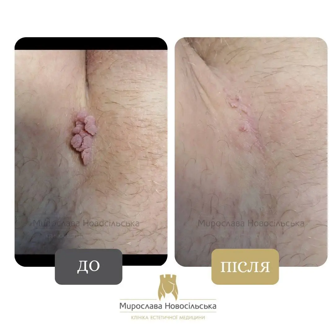 Лазерне видалення новоутворення, фото 3