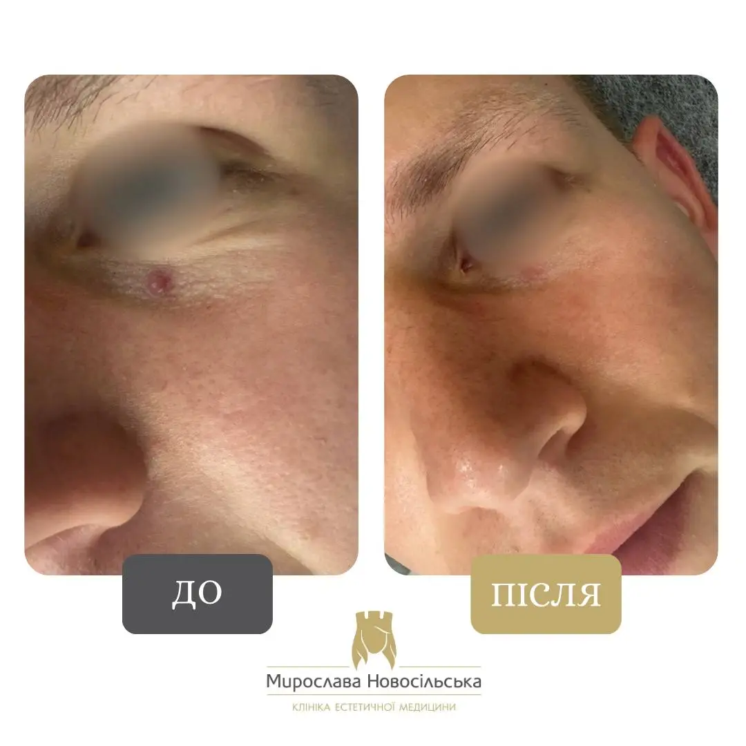 Лазерне видалення новоутворення, фото 6