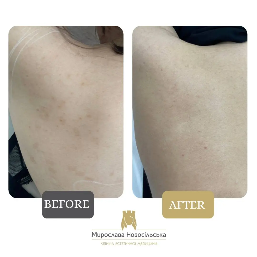 Laser removal of pigment spots