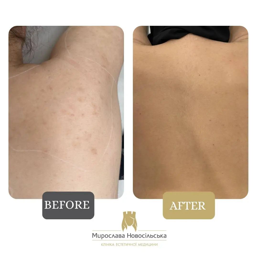 Laser removal of pigment spots