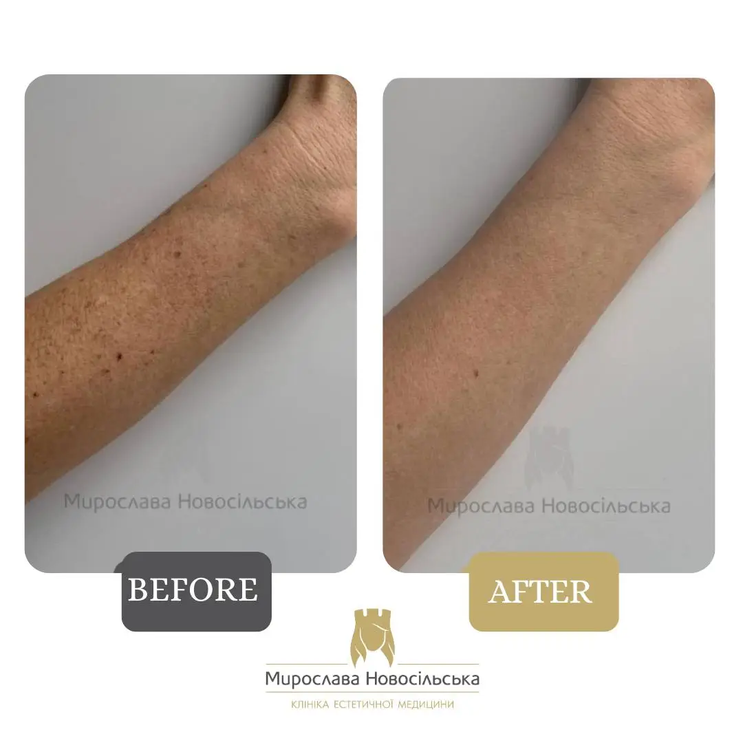 Laser removal of pigment spots, photo 10