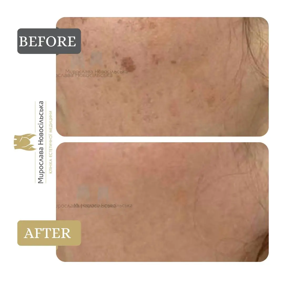 Laser removal of pigment spots
