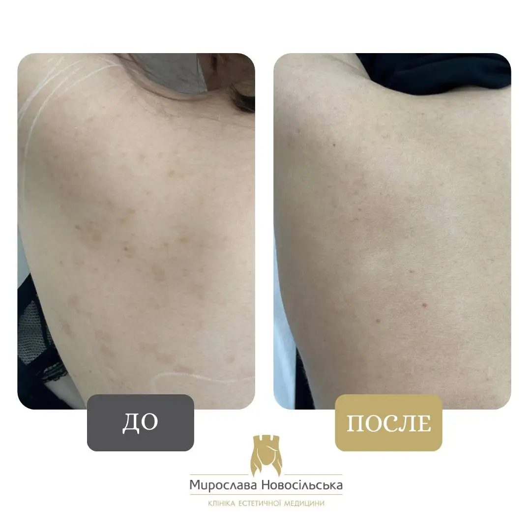 Лазерное удаление пигментации, фото 4