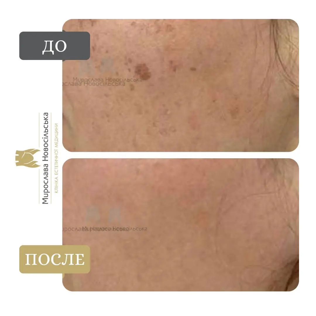 Лазерное удаление пигментации, фото 5