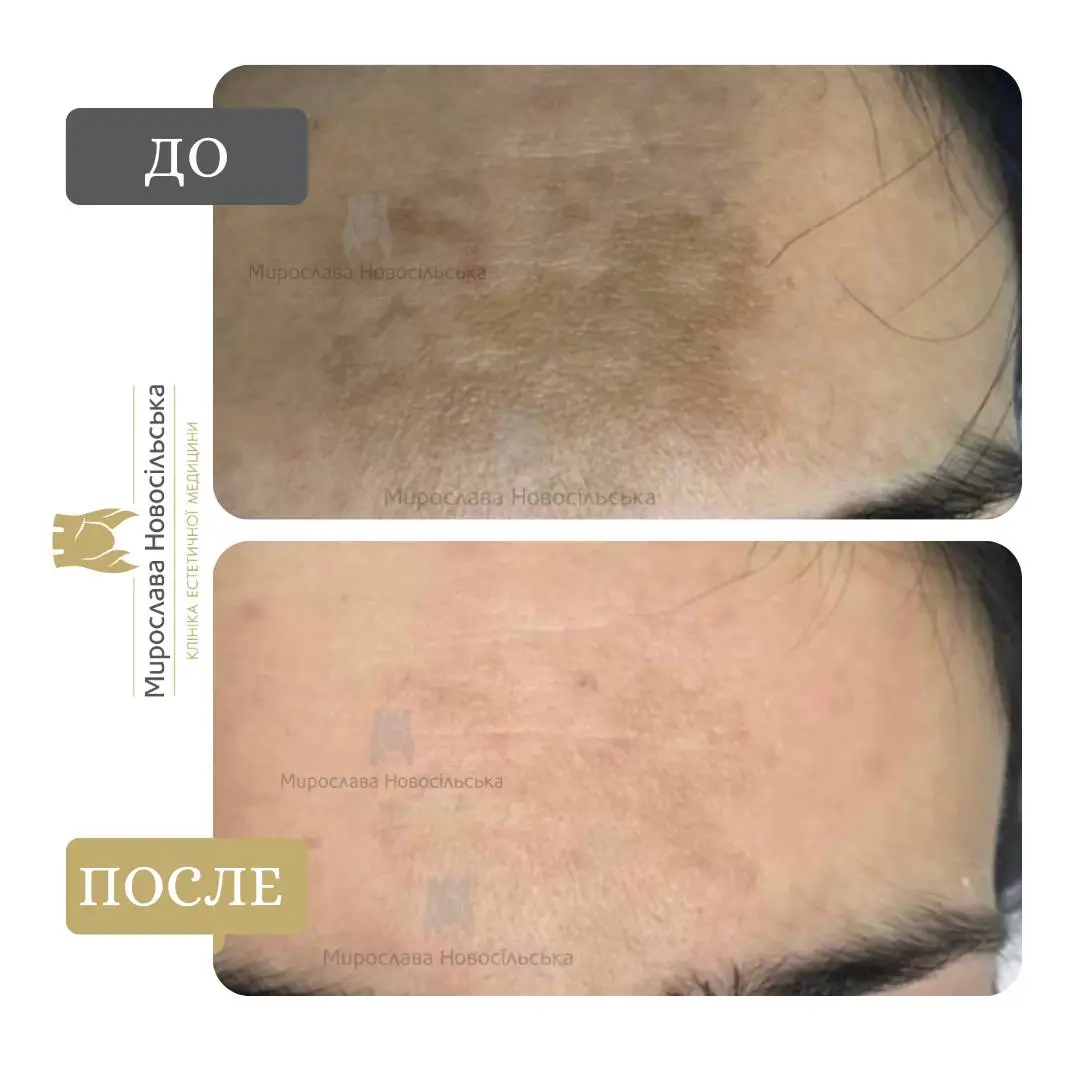 Лазерное удаление веснушек, фото 7