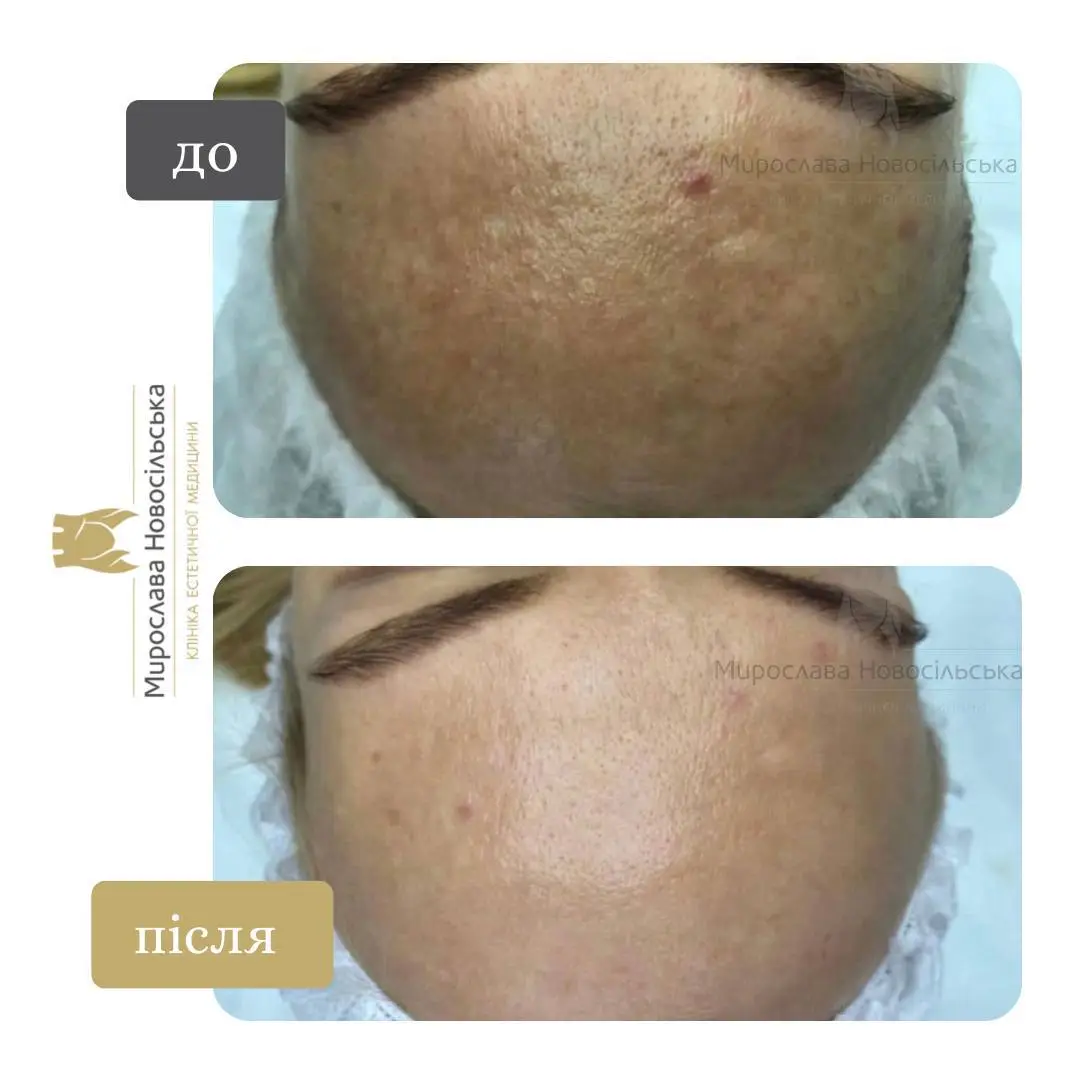 Лазерне видалення веснянок, фото 6