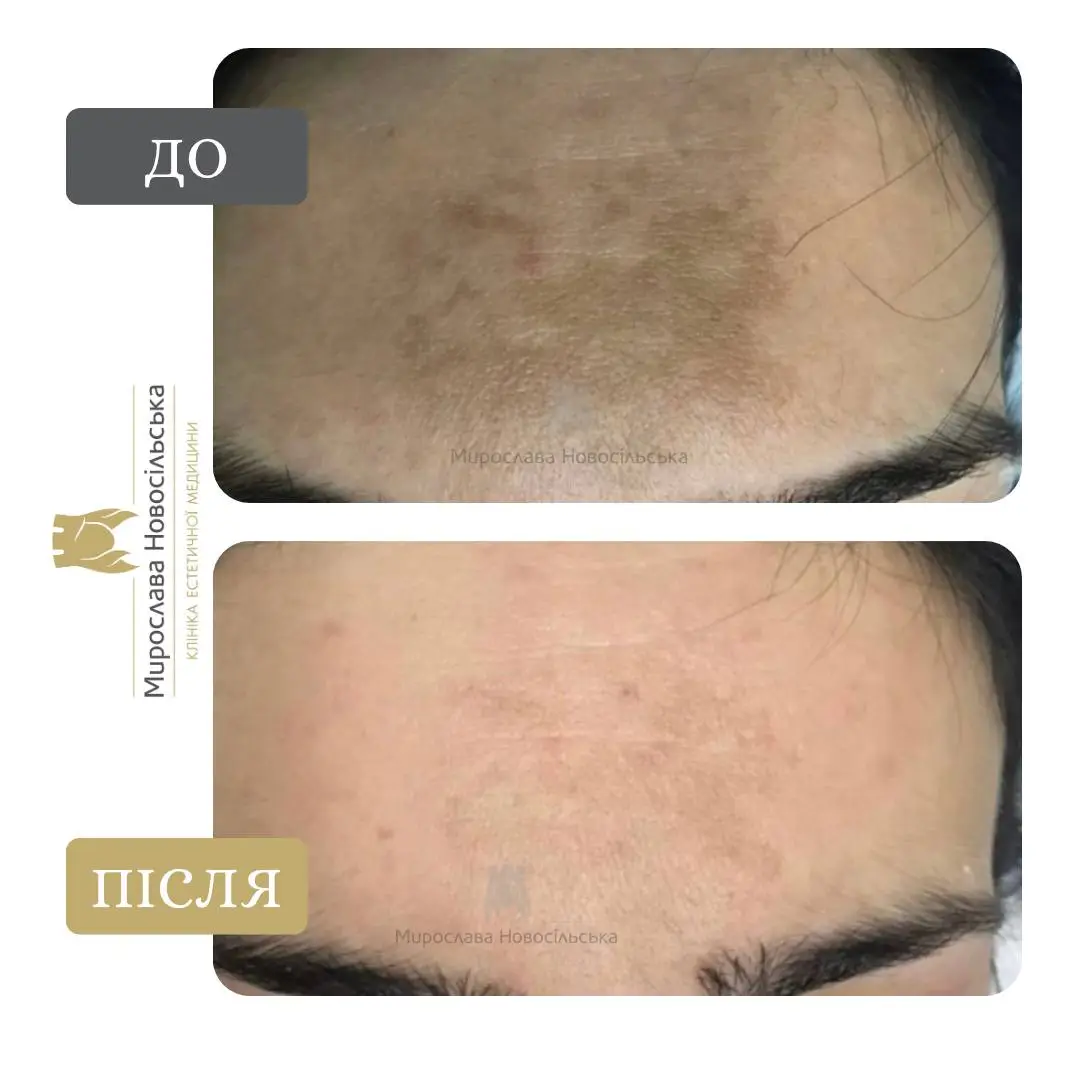 Лазерне видалення веснянок, фото 7