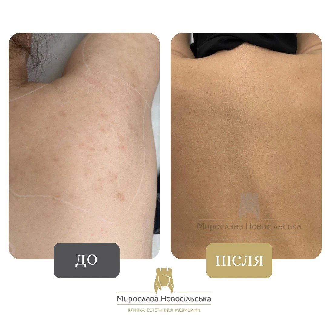 Лазерне видалення веснянок, фото 8