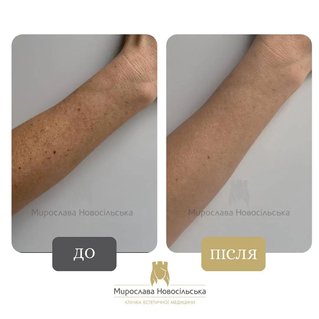 Лазерне видалення веснянок, фото 9