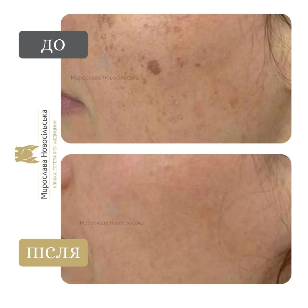 Лазерне видалення веснянок, фото 4