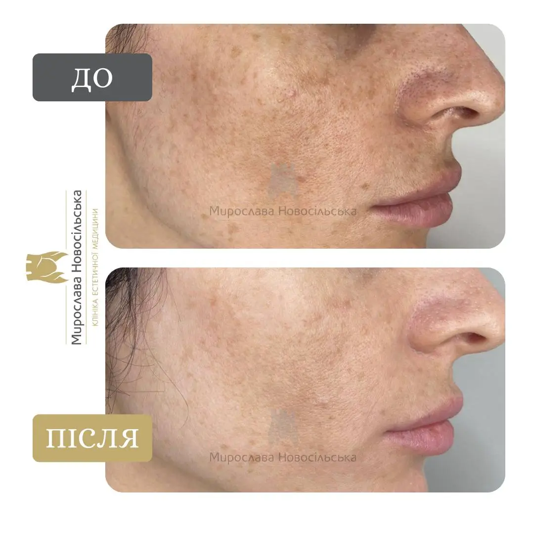 Лазерне видалення веснянок, фото 5