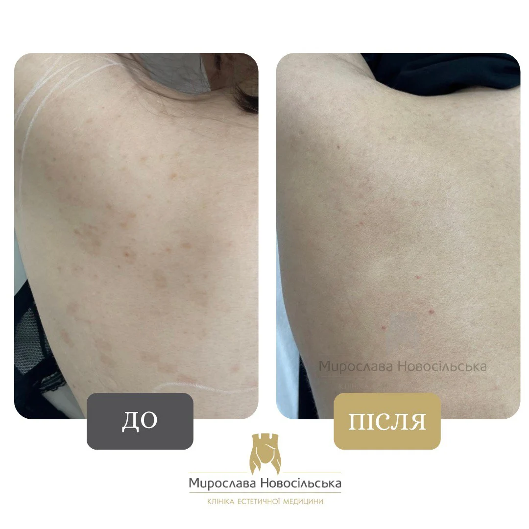 Лазерне видалення веснянок, фото 2