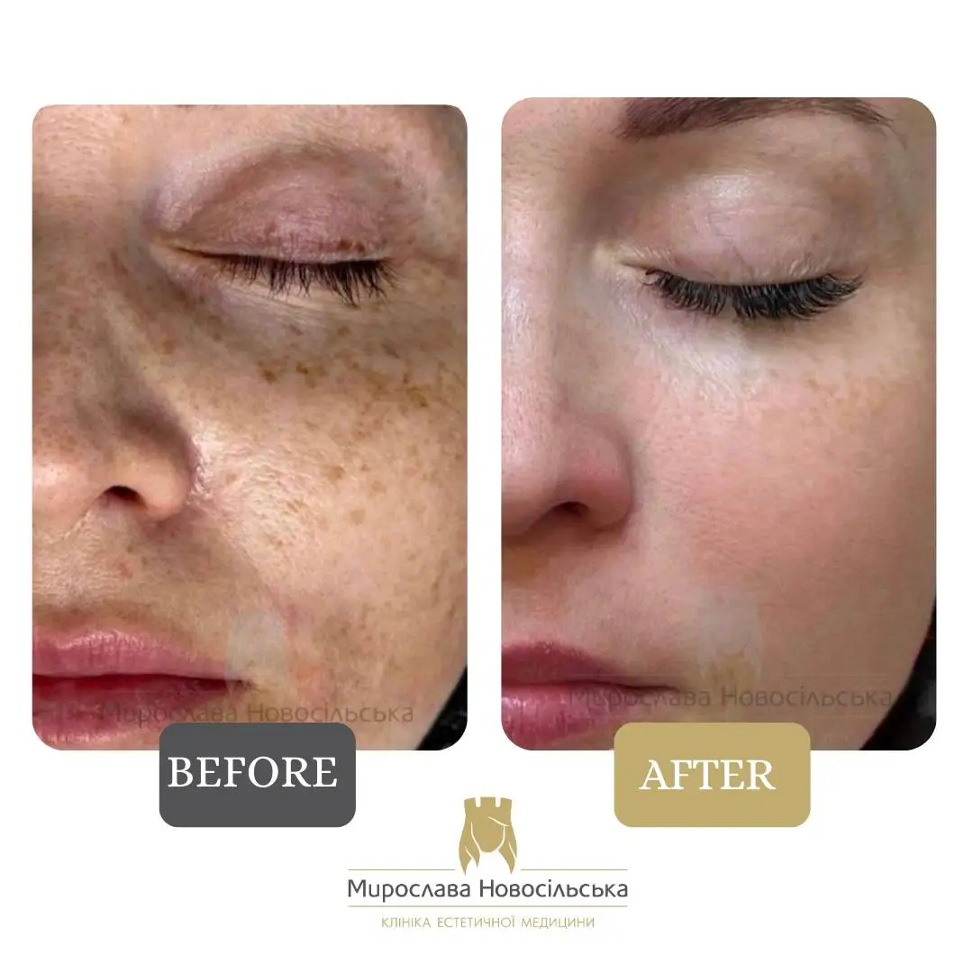 Laser removal of pigment spots on the face, photo 2