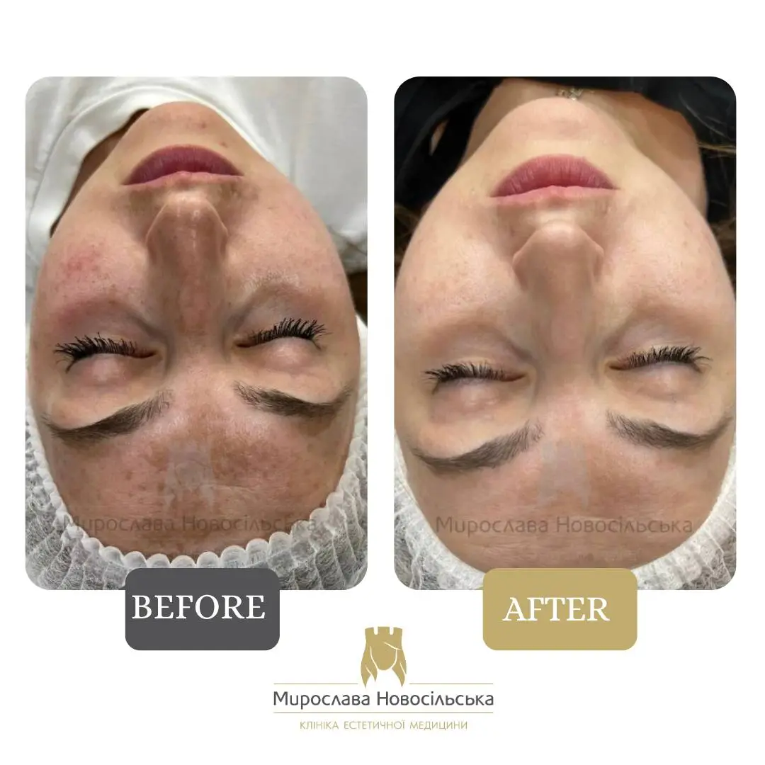 Laser removal of pigment spots on the face, photo 9