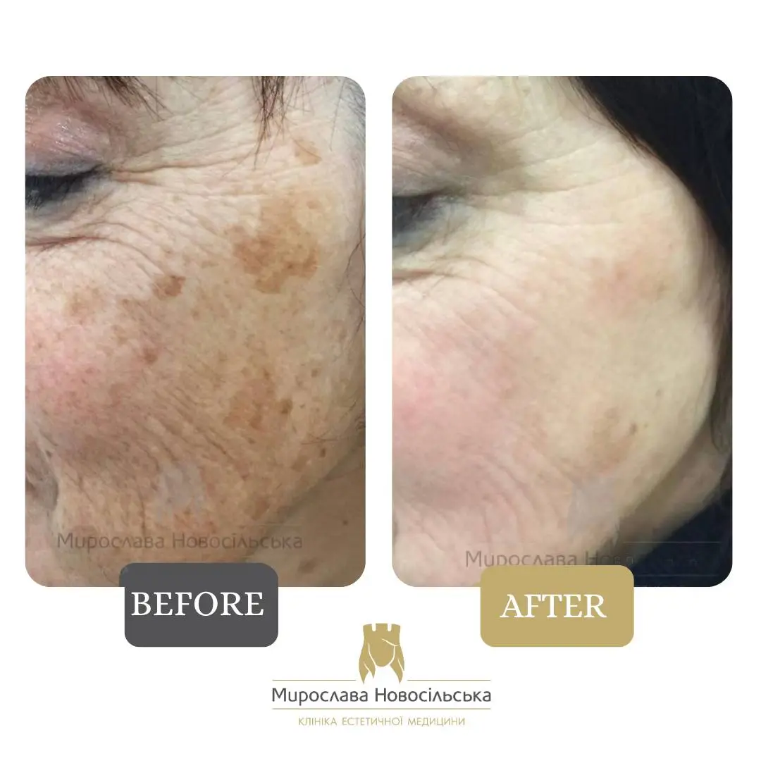 Laser removal of pigment spots on the face