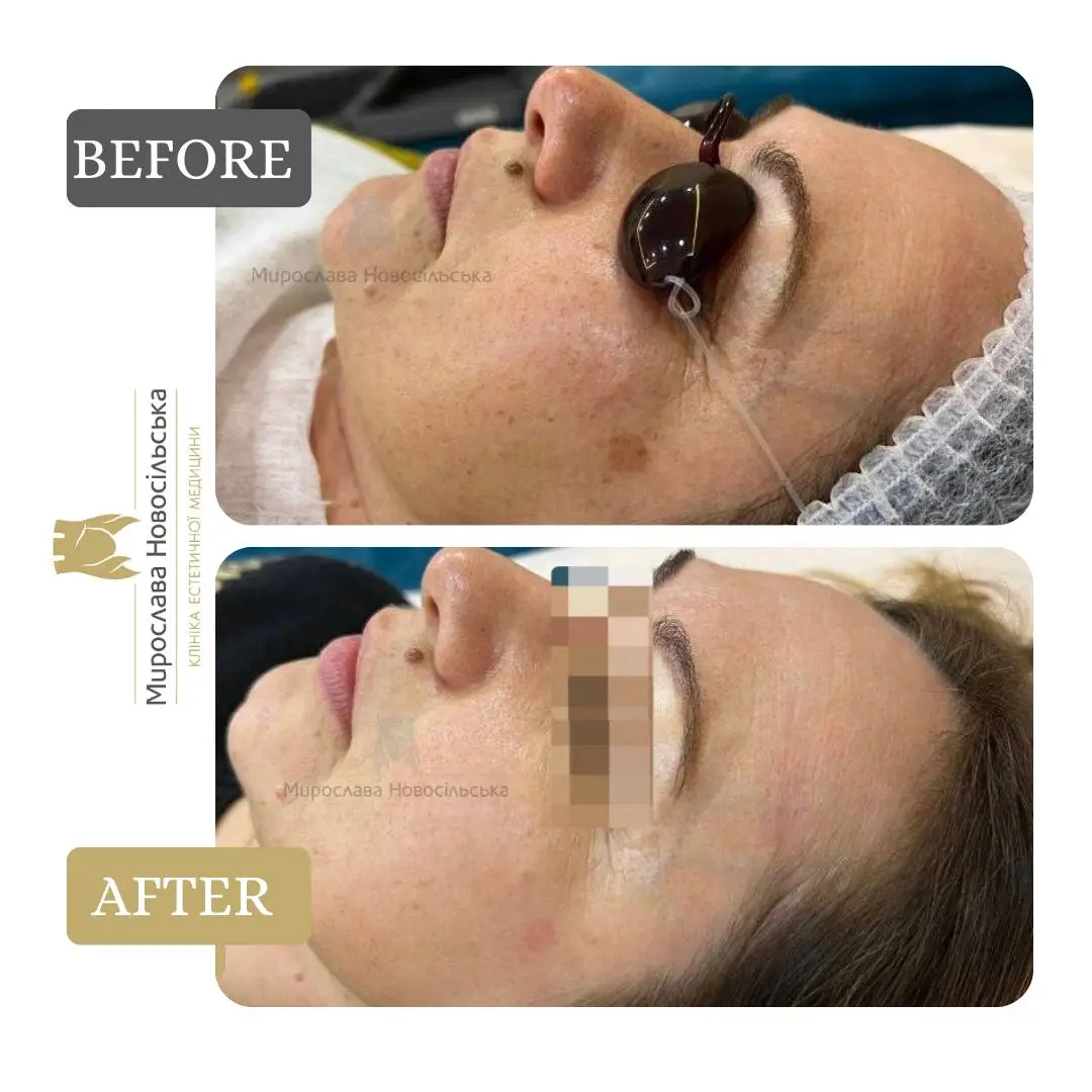 Laser removal of pigment spots on the face