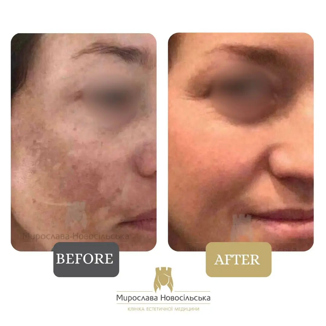 Laser removal of pigment spots on the face