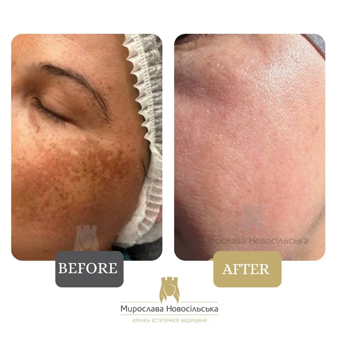 Laser removal of pigment spots on the face