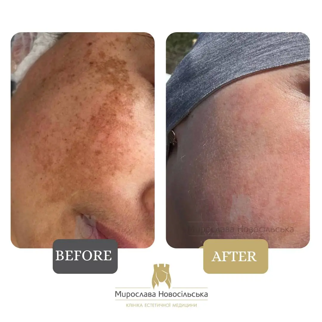 Laser removal of pigment spots on the face