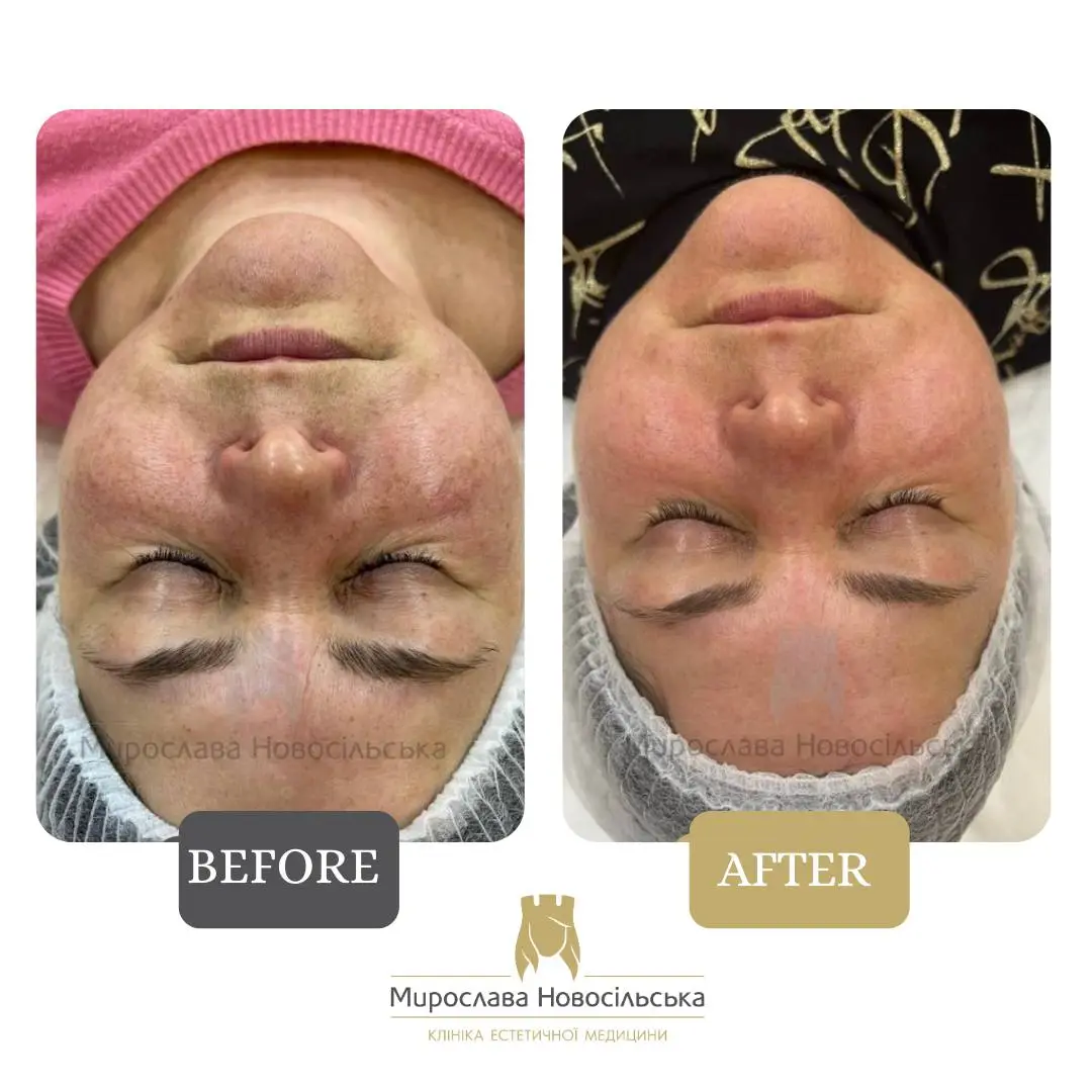 Laser removal of pigment spots on the face, photo 7