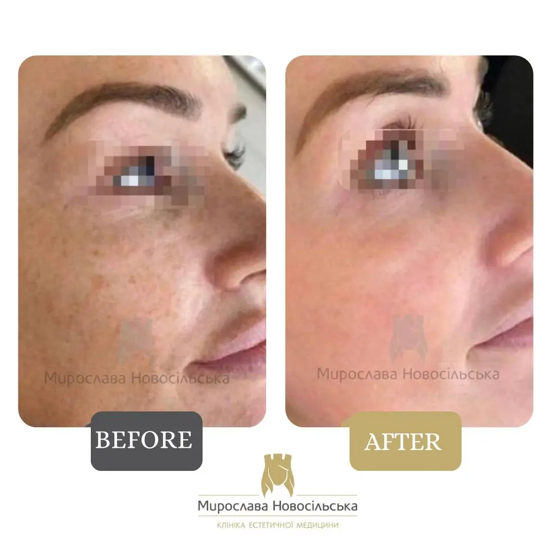 Laser removal of pigment spots on the face, photo 8