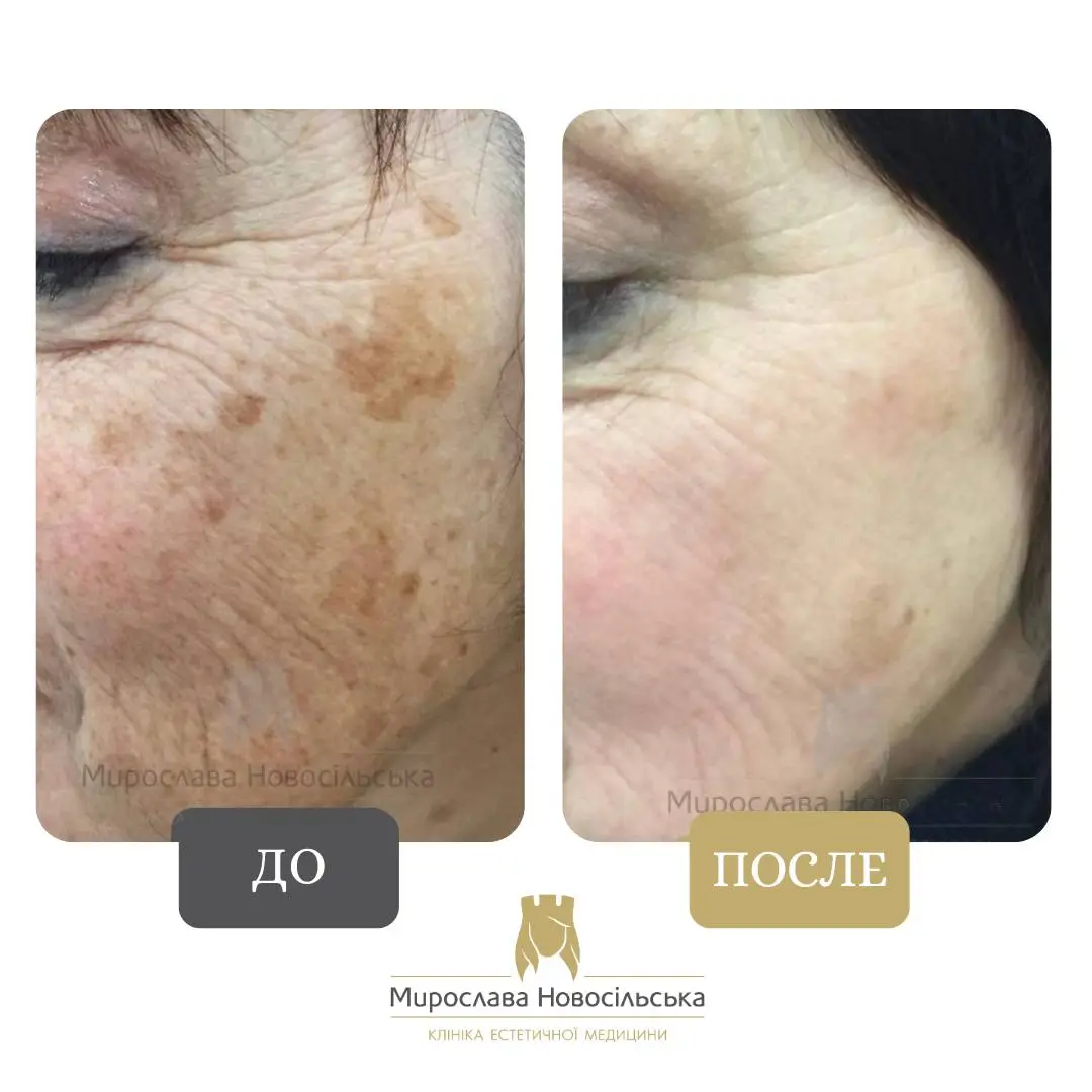 Лазерное удаление пигментных пятен на лице, фото 3