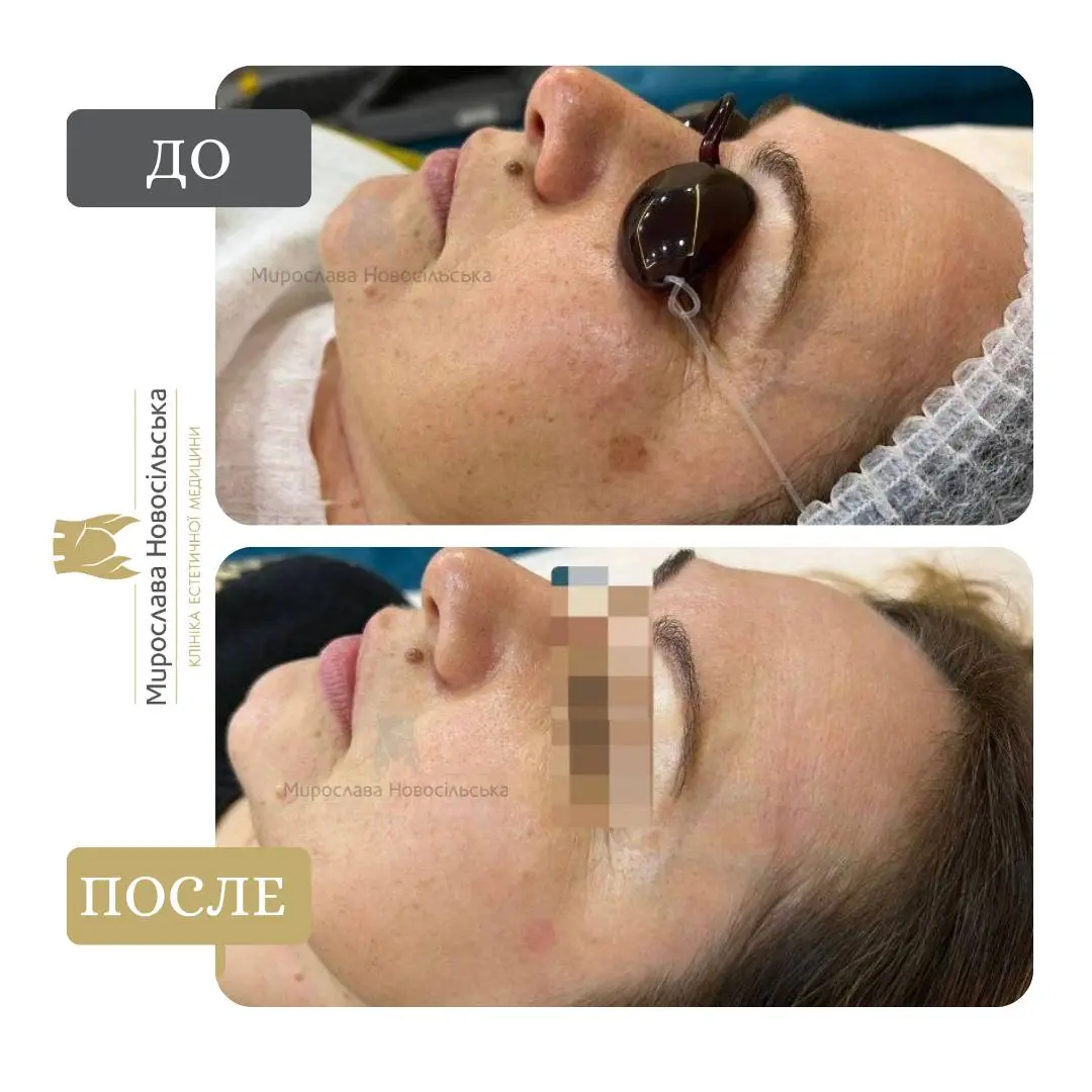 Лазерное удаление пигментации, фото 3