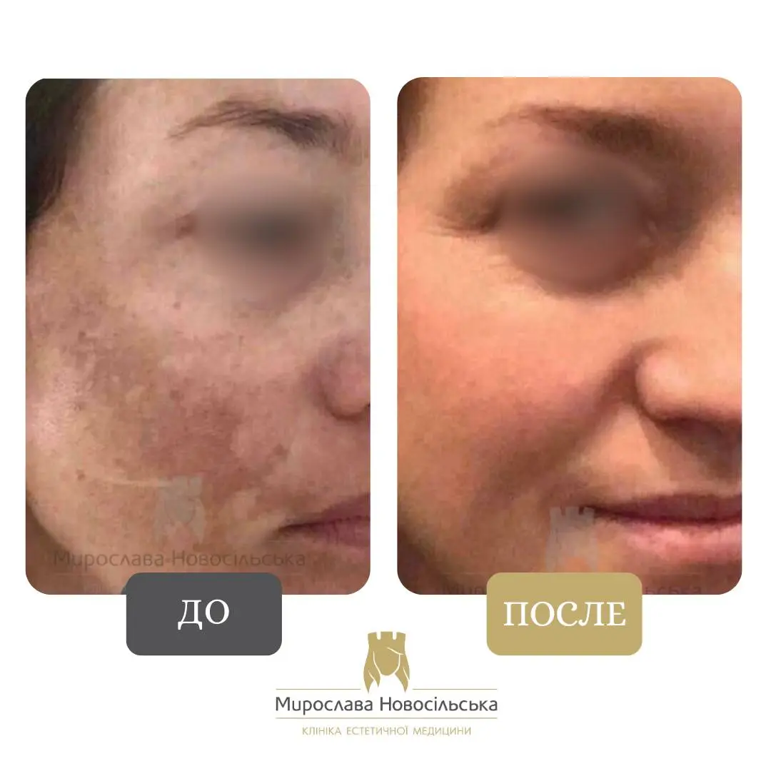 Лазерное удаление пигментных пятен на лице, фото 10