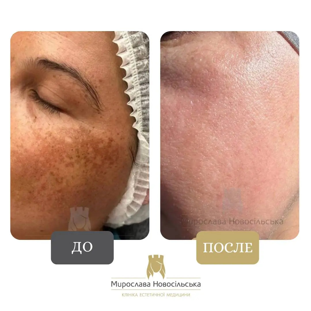 Лазерное удаление пигментных пятен на лице, фото 5