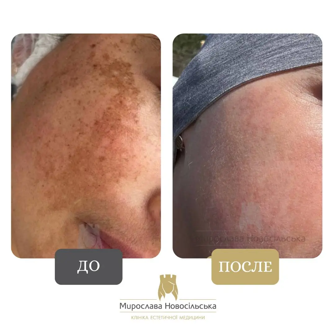 Лазерное удаление пигментных пятен на лице, фото 6