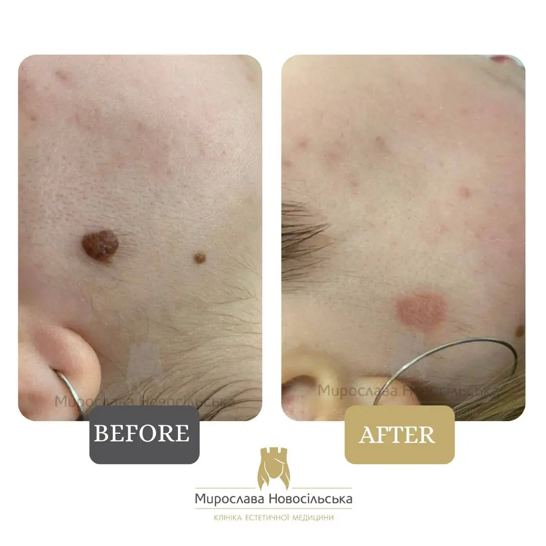 Laser removal of moles on the face