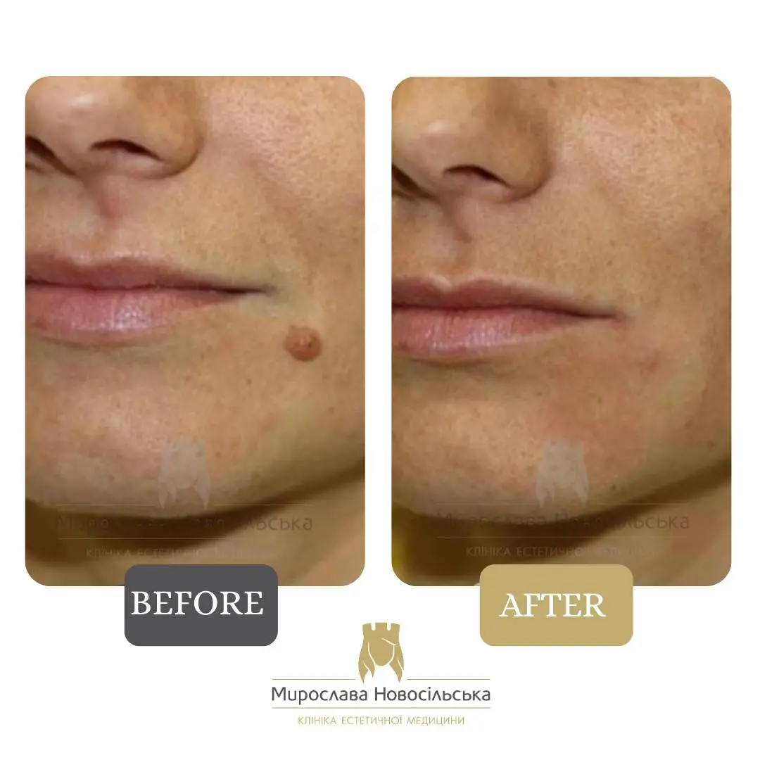 Laser removal of moles on the face