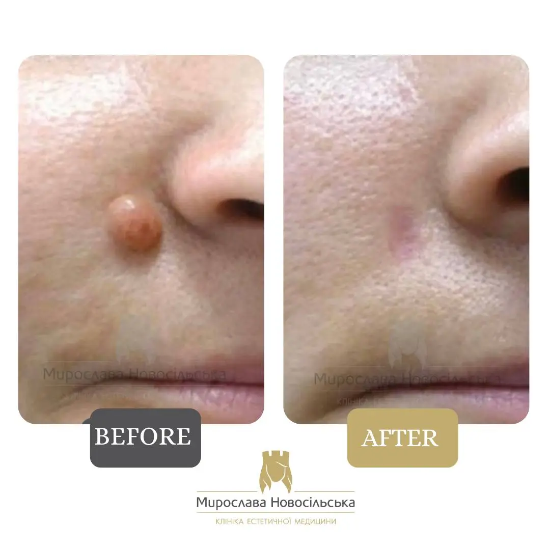 Laser removal of moles on the face