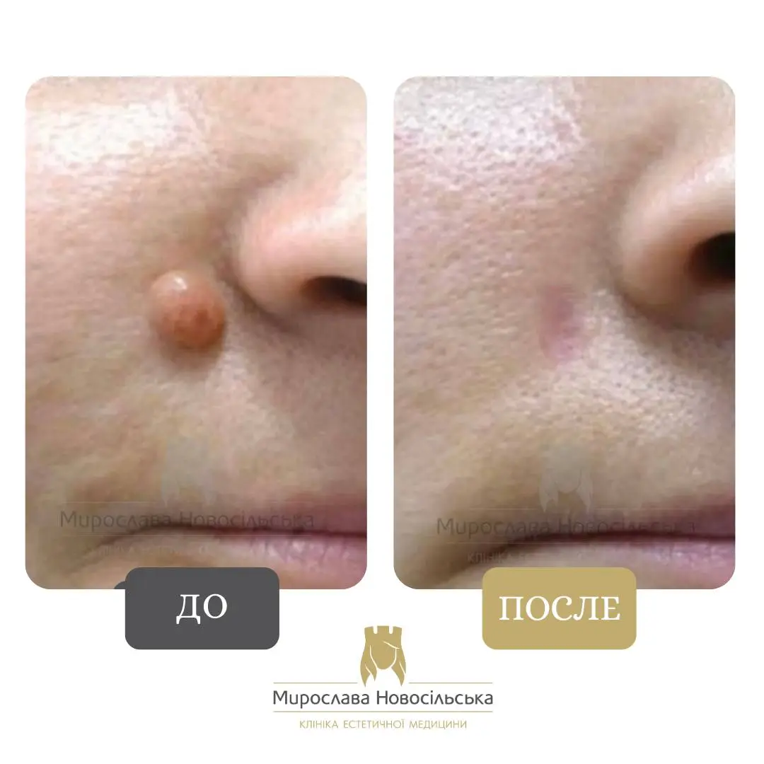 Лазерное удаление родинок на лице, фото 4
