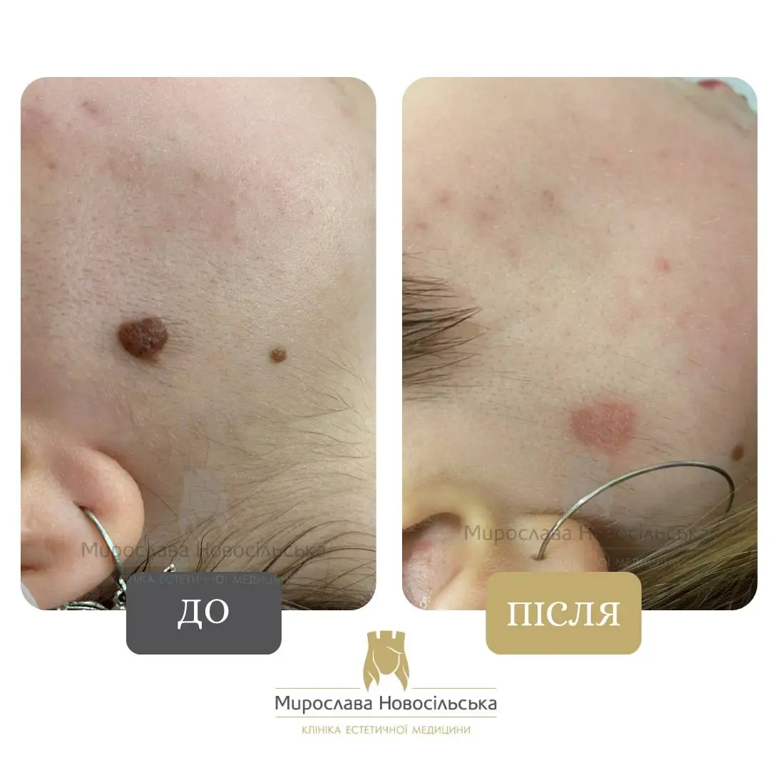 Лазерне видалення родимок на обличчі, фото 2