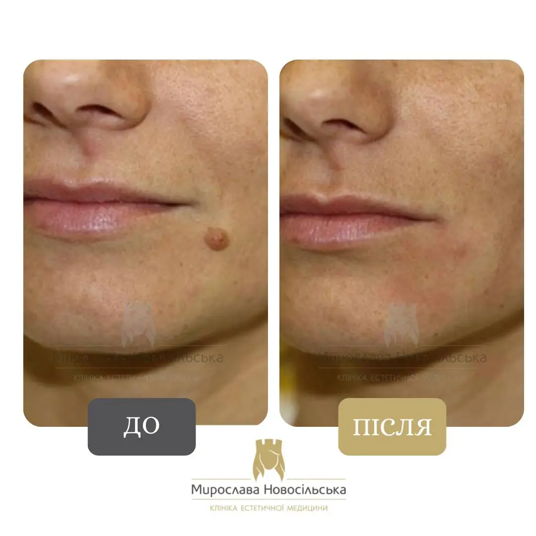 Лазерне видалення родимок на обличчі, фото 3