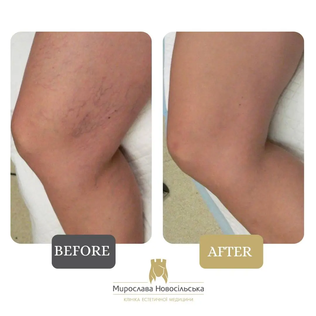 Laser removal of blood vessels on the legs
