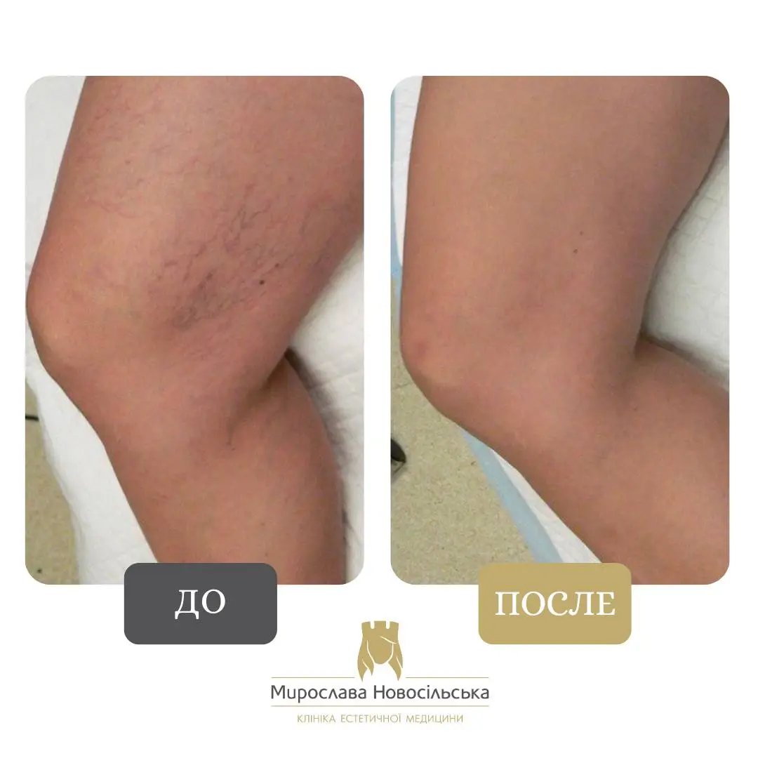 Лазерное удаление сосудов, фото 10