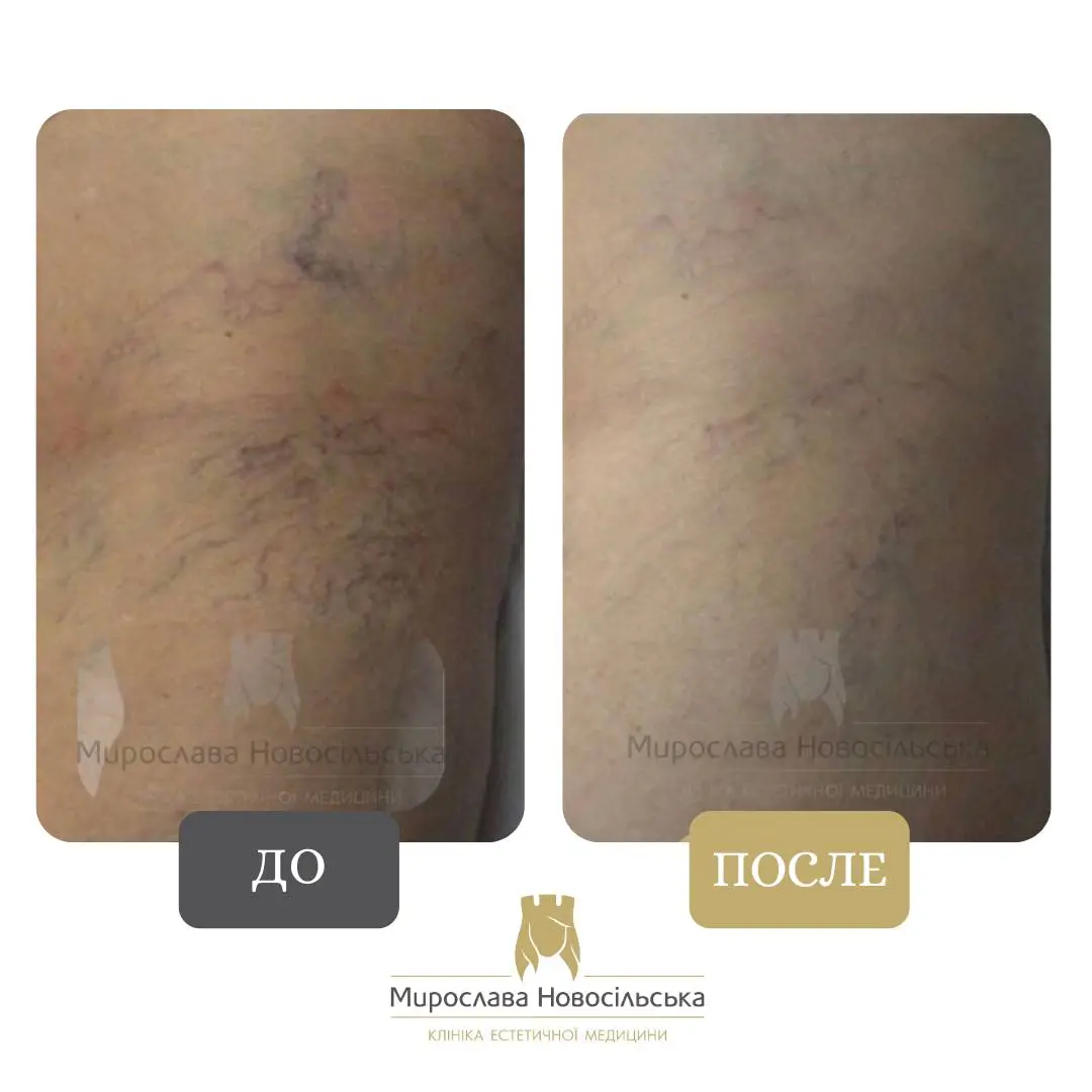 Лазерное удаление сосудов, фото 9