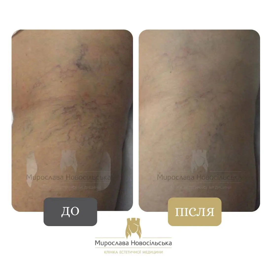 Лазерне видалення судин, фото 9
