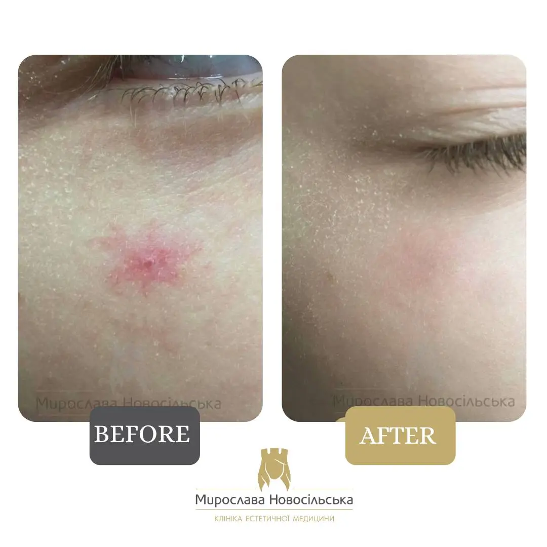 Laser removal of vascular meshes and stars, photo 2